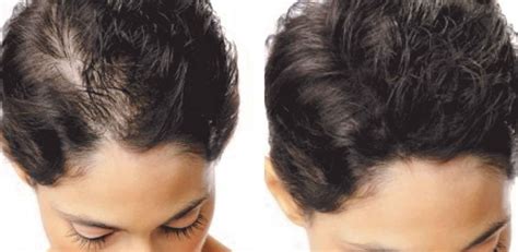 Haartransplantatie Na Zorg: Tips Voor Een Snel Herstel