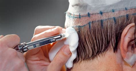 Wat Zijn De Kosten Van Haartransplantatie In Nederland?